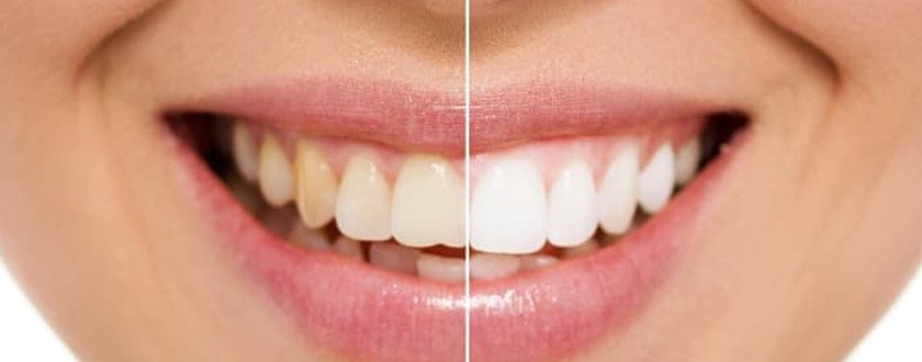 Bleaching / Whitening