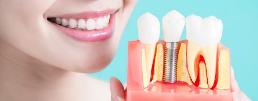 Dental Implants