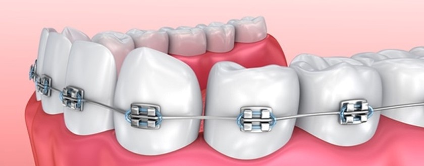 Orthodontics